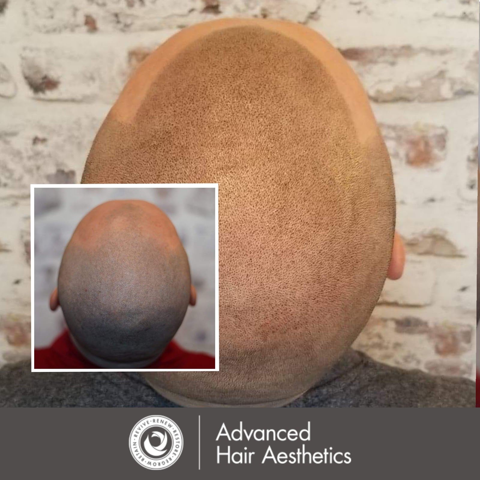 His Hair Clinic @ Advanced Hair Aesthetics, tattoo shop in Del Mar, CA